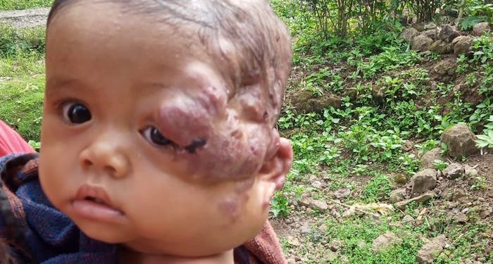 Mengidap Tumor, Bayi Ini Butuh Doa dan Uluran Tangan