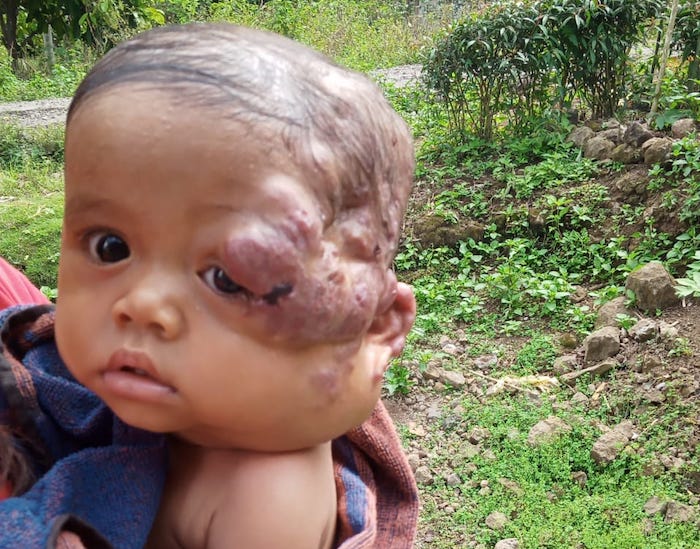 Mengidap Tumor, Bayi Ini Butuh Doa dan Uluran Tangan
