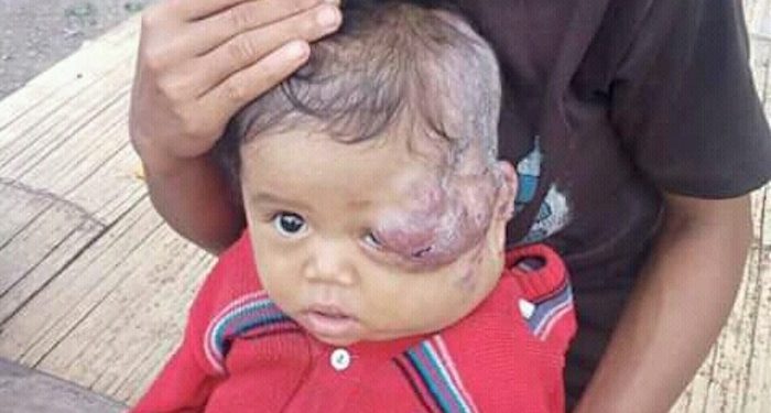 Mengidap Tumor, Bayi Ini Butuh Doa dan Uluran Tangan